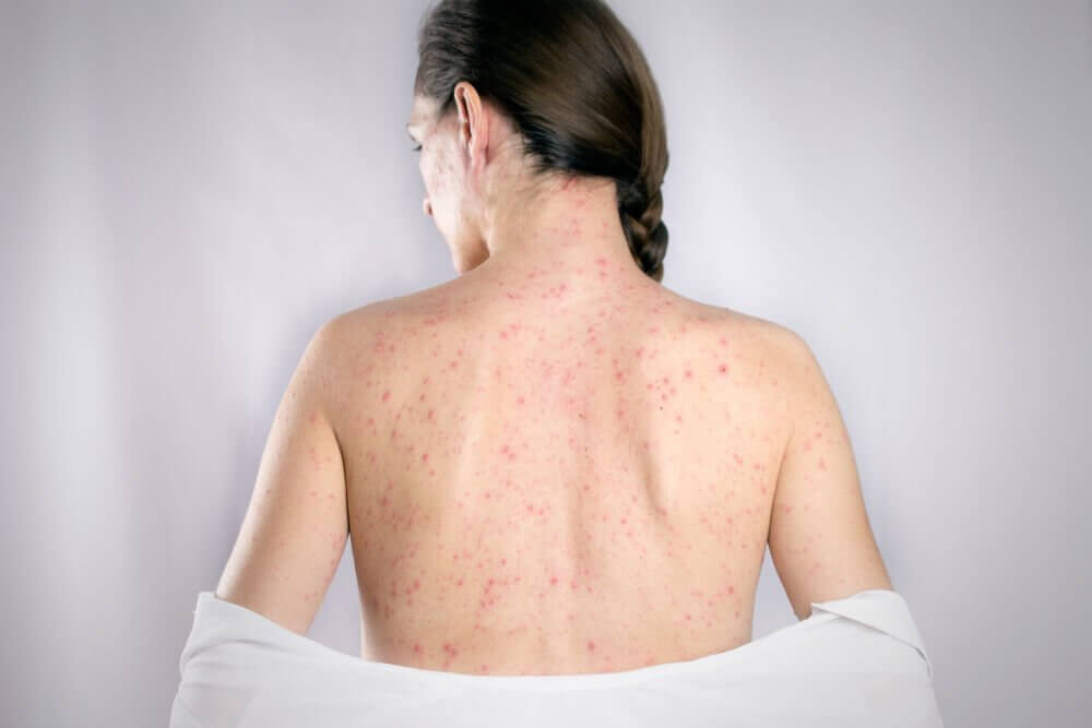 lherpes può portare alla prostatite
